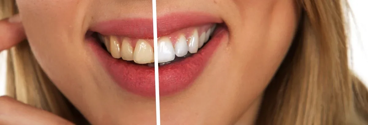 D'où viennent les tâches sur les dents
