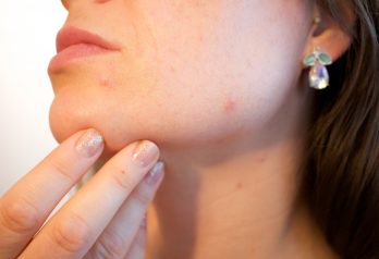 Conseils pour lutter contre les acnés